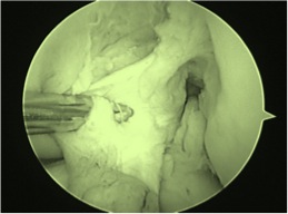 Replace the ACL? More Research