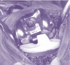 Is previous knee arthroscopy realted to a worse outcome after total knee replacement?