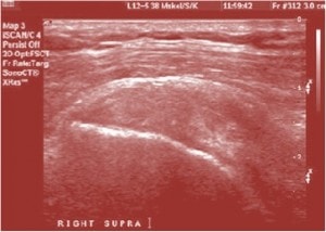 If you Ignore a Rotator Cuff Tear: Will its Size Change?