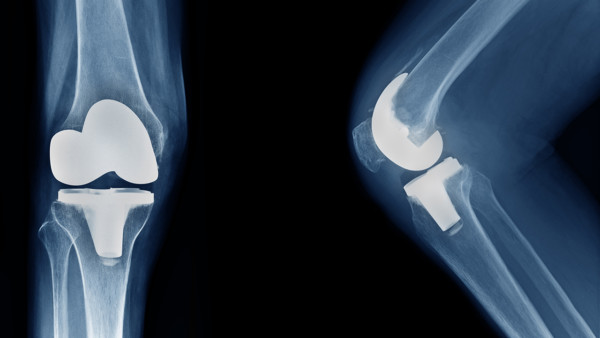 X-ray show knee joint replacement from the front and the side