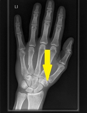 The Evidence Supporting Surgery for Thumb Arthitis