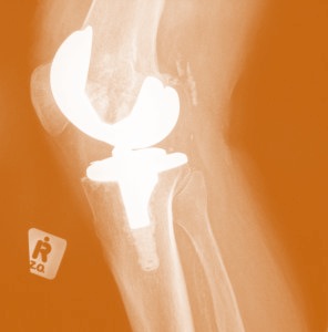 Chronic Knee Cap Pain after Total Knee Replacement Suprisingly Common