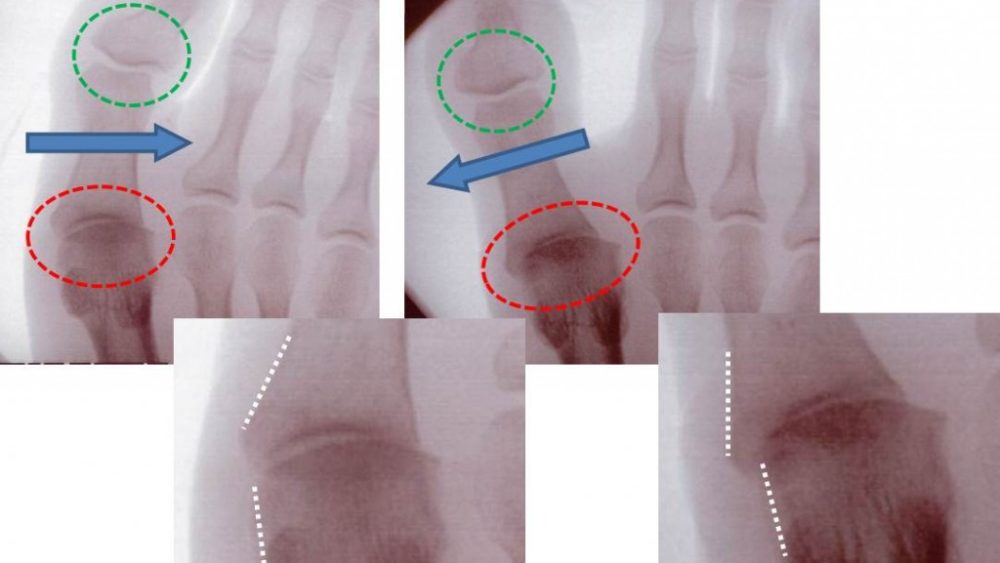 Toe Pain with Walking: Instability Causing More Arthritis