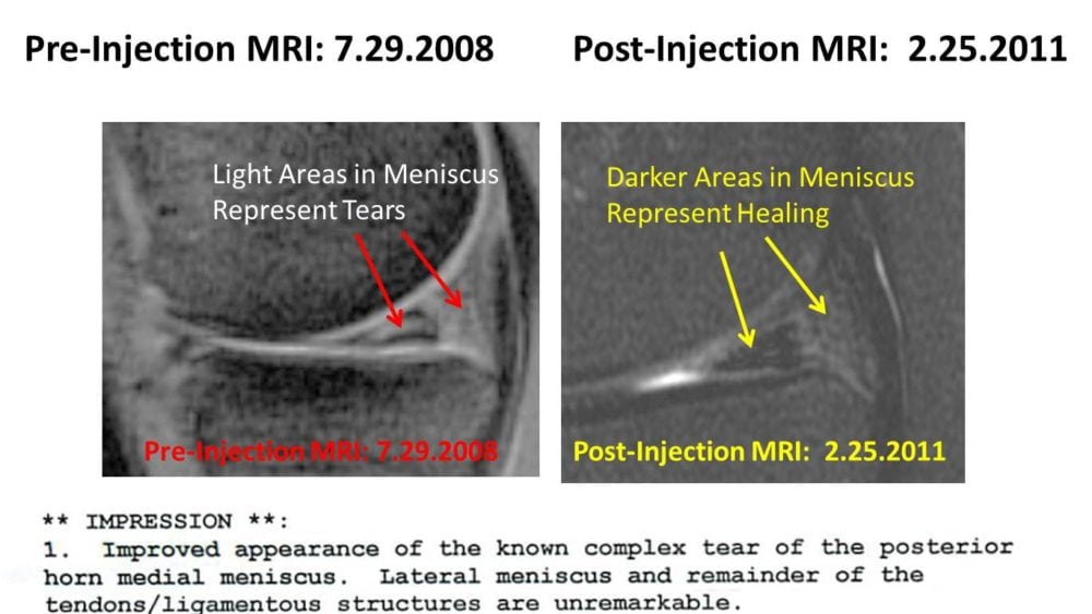 Successful Treatment of Another Meniscus Tear with Stem cells