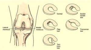 Meniscus Tears found at time of ACL Surgery: Leaving them Alone seems to Work Just Fine