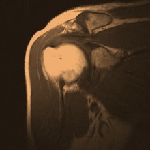 Most Tears in the Rotator Cuff don’t cause Symptoms