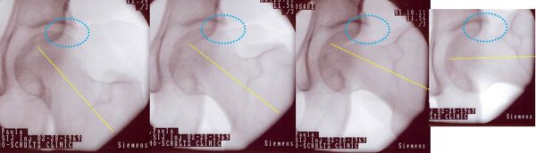 Series of four MRIs showing hip impingement