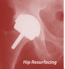 Hip Replacement Side Effects in the News