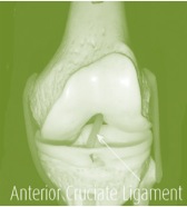 Women may be at Higher Risk of Knee Arthritis after ACL Reconstruction