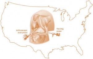 Dramatically Higher Rate of Knee Arthroscopy in the United States. Are we Getting what We’re Paying For?