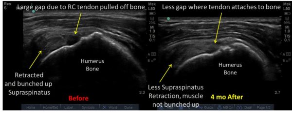 Two ultrasounds showing the before and after of retractedr rotator cuff tear stem cell injection