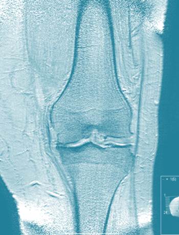 Weight Gain and Knee Pain: A New Study Sheds Light on the Effects of not Shedding Pounds