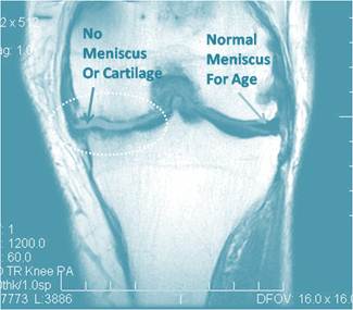 What predicts which patients will need a knee replacement?