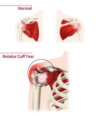 Medical illustration showing a healthy shoulder muscle and a shoulder affected by a rotator cuff tear