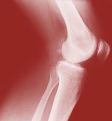How to help knee arthritis?
