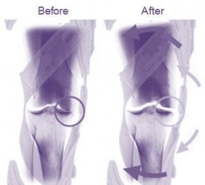 Fat and Bone Marrow Stem Cells used to Treat Severe Knee Arthritis