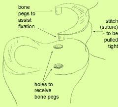 Problems with Meniscus Allografts Surface