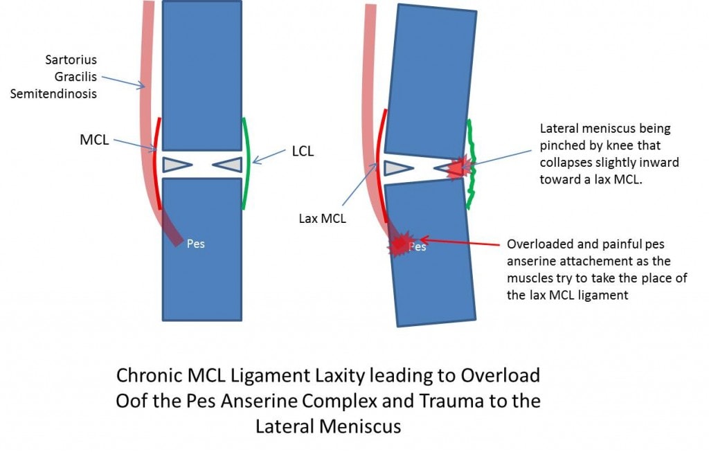 Knee Inside Pain The Tennis Elbow of the Knee