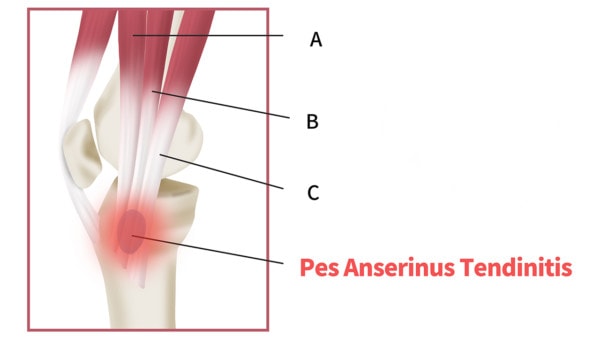 Medical illustration showing pes anserinus tendinitis