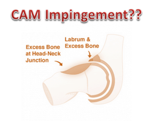 FAI and CAM Impingement found in Normal Pain-free Hips!