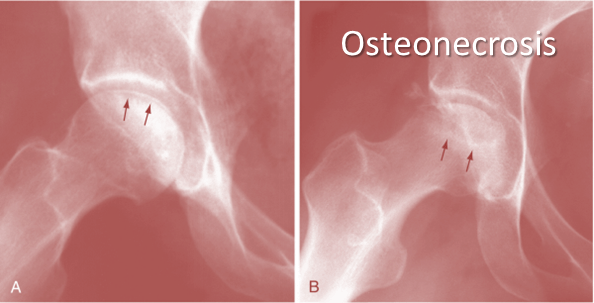 osteonecrosis steroids