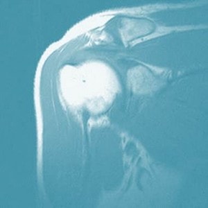 Is Your Abnormal Shoulder Mri Really Normal Is Your Abnormal Shoulder Mri Really Normal