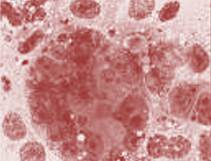 Adipose Stem Cells Cause Cancer?  Or Man Bites Dog and Other Confounders…