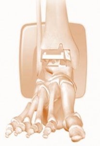 Ankle Replacement Complications: How long do ankle replacements last?