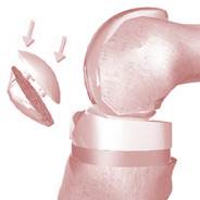 No Advantage to Resurfacing of the Knee Cap with Total Knee Replacement