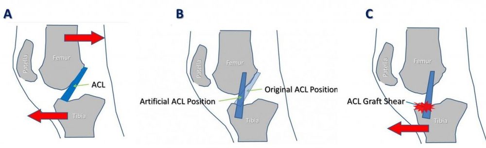 Beware: A Surgically Replaced ACL is not like the Original Equipment