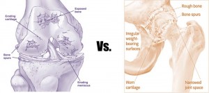 knee vs. hip arthritis