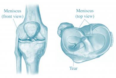 Meniscus Tear treated with Stem Cells rather than Surgery
