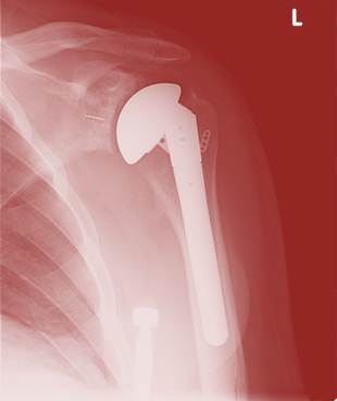 Saving a Young Man’s Damaged Shoulder with Interventional Orthopedics