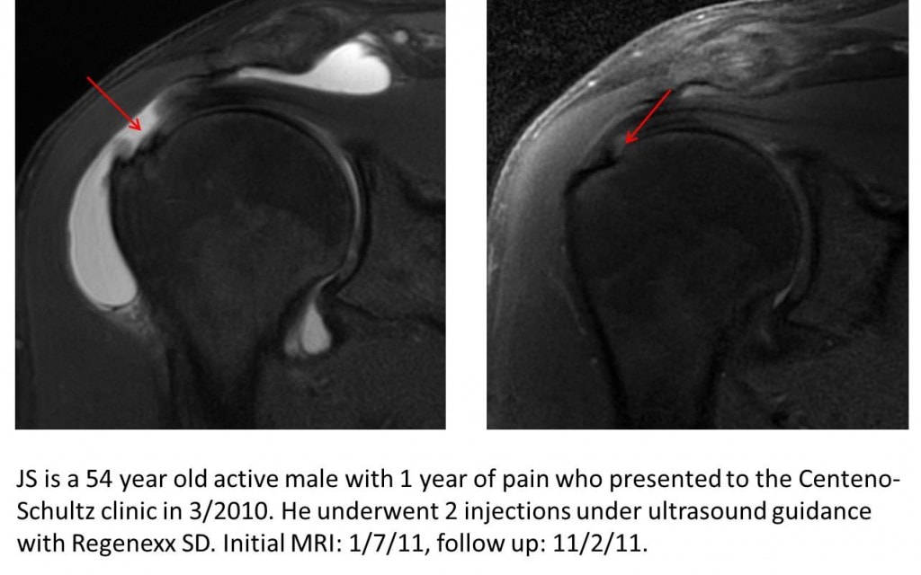 Steroid Injection Rotator Cuff Tear A Positive Correlation between