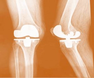 knee replacement alternatives