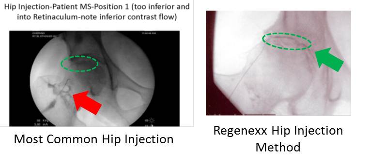 Hip Stem Cell Injections-Are the Cells Getting where they Need to Go?