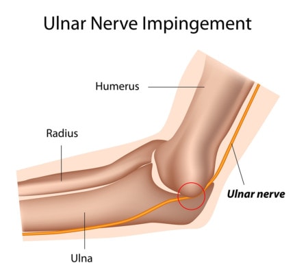 Medical illustration of the elbow showing ulnar nerve impingement