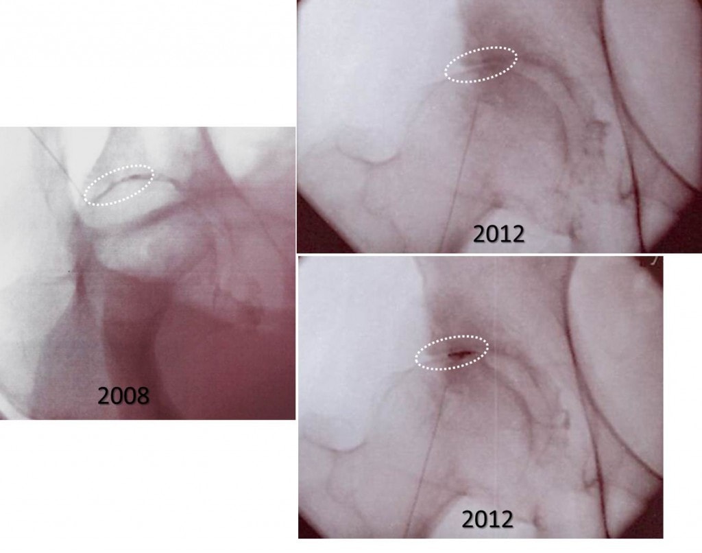 hip stem cell injections