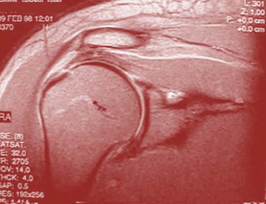 Will Your Rotator Cuff Tear Get Bigger Without Surgery?