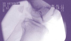 knee acl surgery alternative