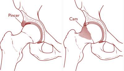 Three Hip CAM/Pincer FAI Surgeries and still Hip Pain?