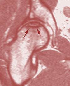 A Modern Greek Tragedy-Small Amounts of Steroid Use can Lead to Osteonecrosis
