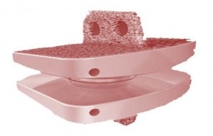 Artificial Low Back Discs Release Metal Ions Too