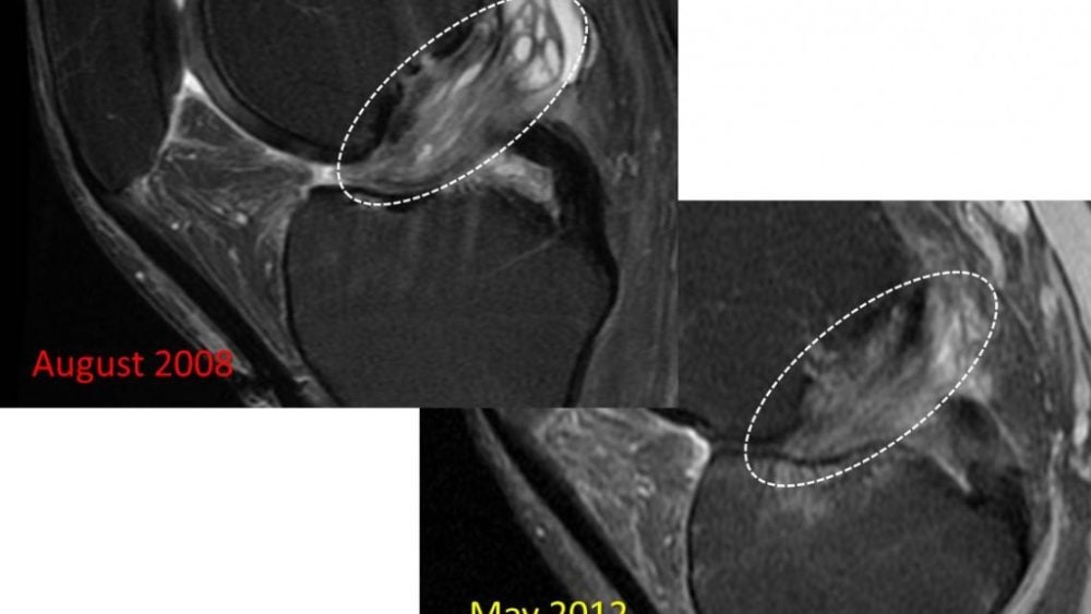 4 year Follow-up on a Patient with Severe Knee Arthritis Treated with Stem Cells