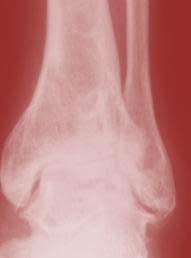 Update on a Stem Cell Treatment for Severe Traumatic Ankle Arthritis