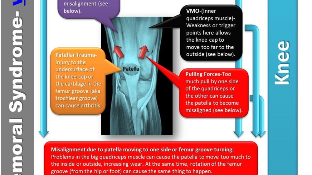 Patellofemoral Pain Syndrome Infographic