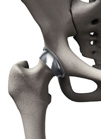 hip replacement alternative
