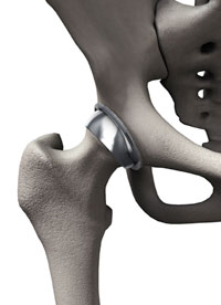 Minimally Invasive Hip Replacement Alternative Has Poor Outcome