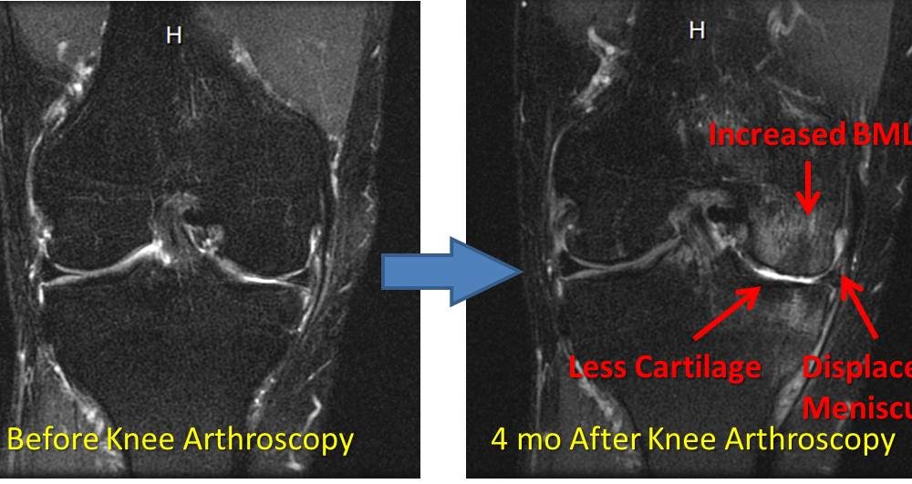 Knee Surgery Complications: Watch a Knee Go from Slightly Abnormal to a Mess in 4 Months!