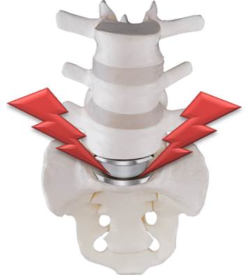 More on Artificial Disc Replacement Side Effects